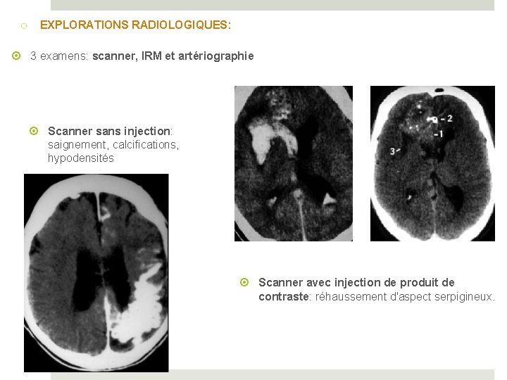 o EXPLORATIONS RADIOLOGIQUES: 3 examens: scanner, IRM et artériographie Scanner sans injection: saignement, calcifications,