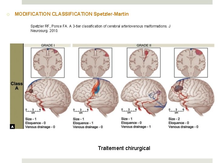 o MODIFICATION CLASSIFICATION Spetzler-Martin Spetzler RF, Ponce FA. A 3 -tier classification of cerebral