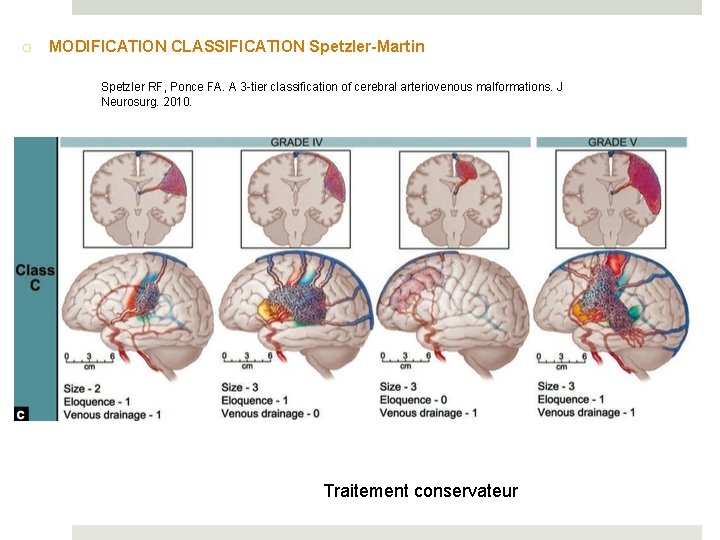 o MODIFICATION CLASSIFICATION Spetzler-Martin Spetzler RF, Ponce FA. A 3 -tier classification of cerebral