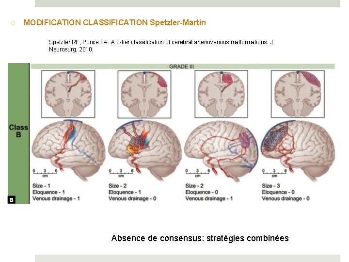o MODIFICATION CLASSIFICATION Spetzler-Martin Spetzler RF, Ponce FA. A 3 -tier classification of cerebral