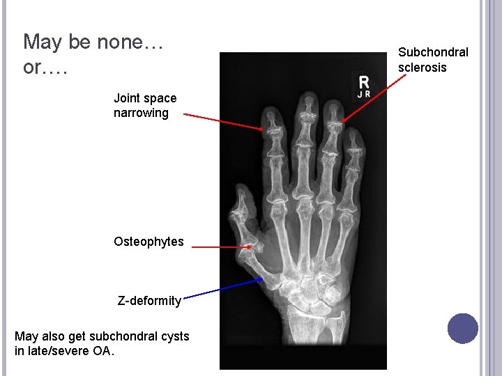 May be none… or…. Joint space narrowing Osteophytes Z-deformity May also get subchondral cysts