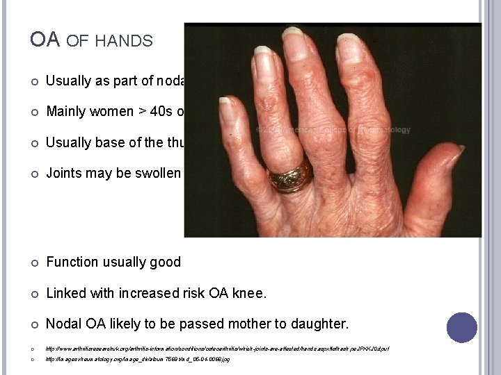 OA OF HANDS Usually as part of nodal osteoarthritis Mainly women > 40 s