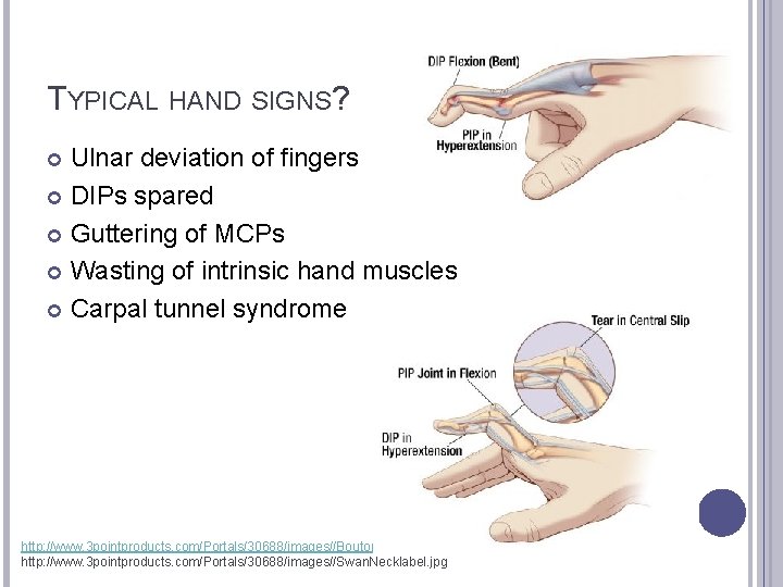 TYPICAL HAND SIGNS? Ulnar deviation of fingers DIPs spared Guttering of MCPs Wasting of