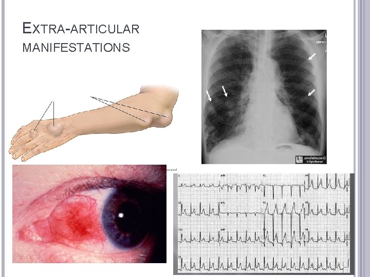 EXTRA-ARTICULAR MANIFESTATIONS 