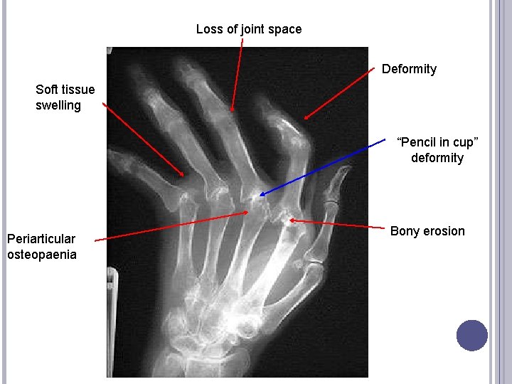 Loss of joint space Deformity Soft tissue swelling “Pencil in cup” deformity Periarticular osteopaenia