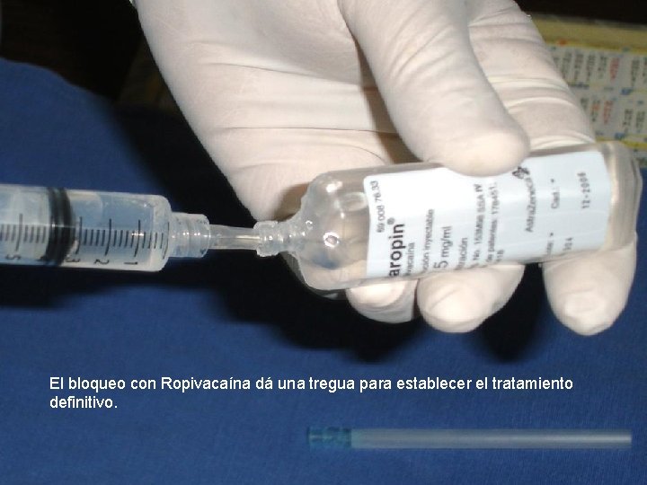 El bloqueo con Ropivacaína dá una tregua para establecer el tratamiento definitivo. 