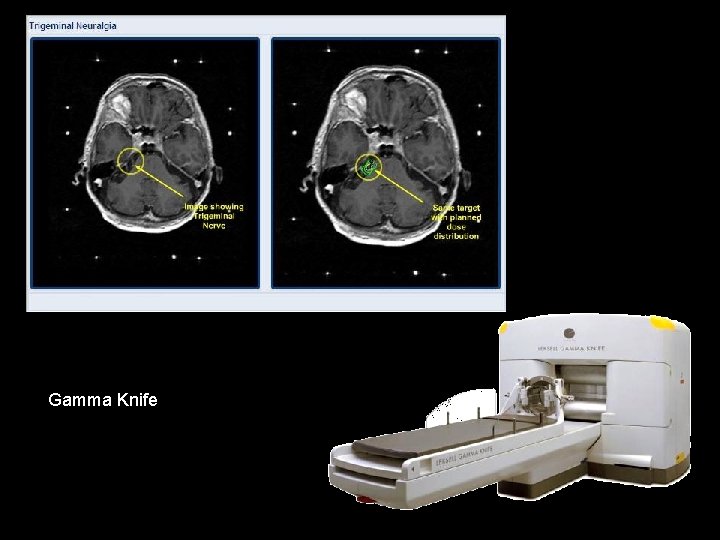 Gamma Knife 