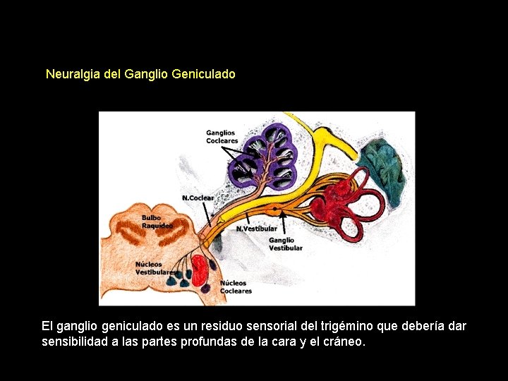 Neuralgia del Ganglio Geniculado El ganglio geniculado es un residuo sensorial del trigémino que