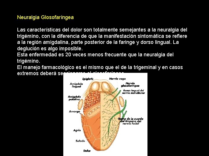Neuralgia Glosofaríngea Las características del dolor son totalmente semejantes a la neuralgia del trigémino,