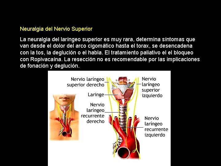 Neuralgia del Nervio Superior La neuralgia del laríngeo superior es muy rara, determina síntomas