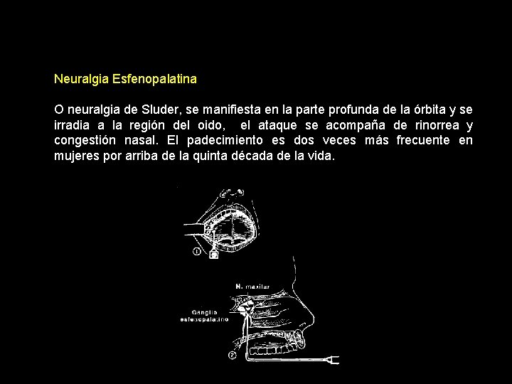 Neuralgia Esfenopalatina O neuralgia de Sluder, se manifiesta en la parte profunda de la