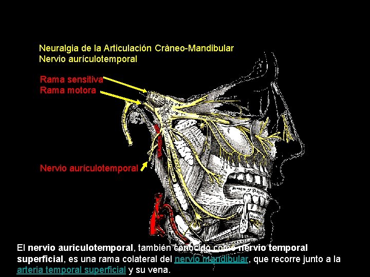 Neuralgia de la Articulación Cràneo-Mandibular Nervio aurículotemporal Rama sensitiva Rama motora Nervio aurículotemporal El