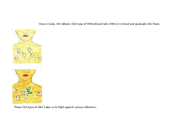 Once in body, HIV attacks CD 4 type of White Blood Cells ( WBCs)