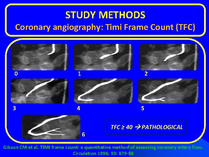 STUDY METHODS Coronary angiography: Timi Frame Count (TFC) 0 1 3 4 2 5