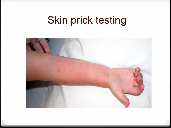 Skin prick testing 