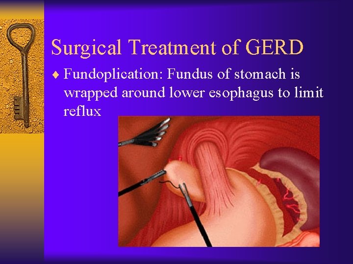 Surgical Treatment of GERD ¨ Fundoplication: Fundus of stomach is wrapped around lower esophagus