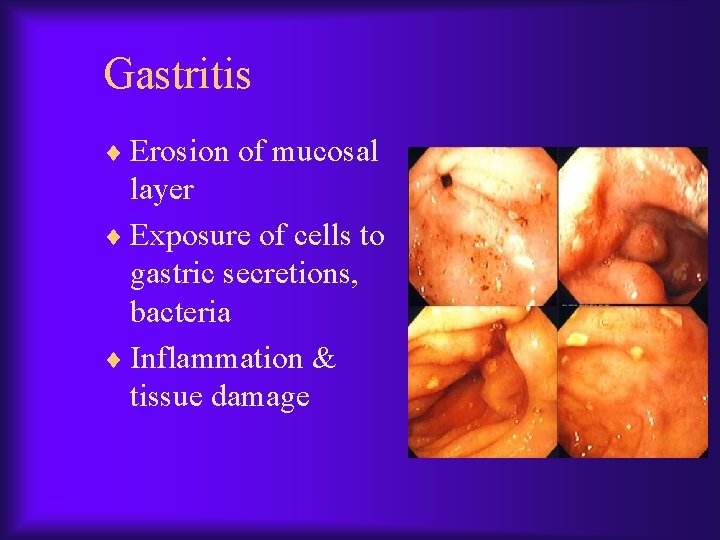 Gastritis ¨ Erosion of mucosal layer ¨ Exposure of cells to gastric secretions, bacteria