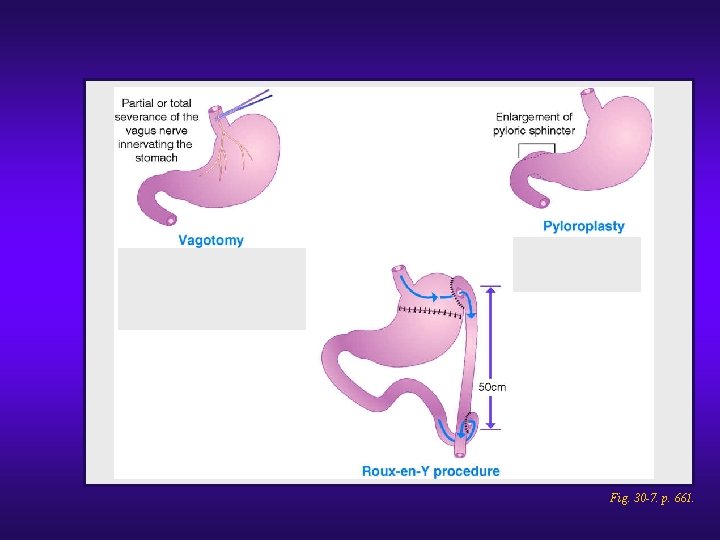 Gastric surgical procedures. (cont. ) Fig. 30 -7. p. 661. 