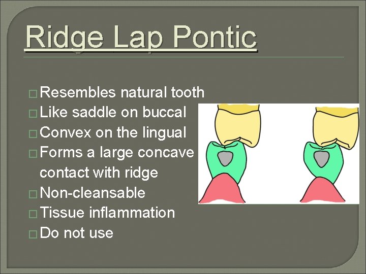 Ridge Lap Pontic � Resembles natural tooth � Like saddle on buccal � Convex