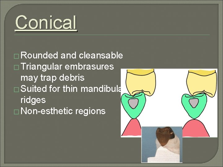 Conical � Rounded and cleansable � Triangular embrasures may trap debris � Suited for