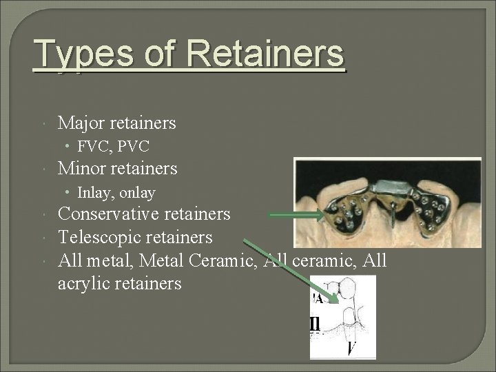 Types of Retainers Major retainers • FVC, PVC Minor retainers • Inlay, onlay Conservative