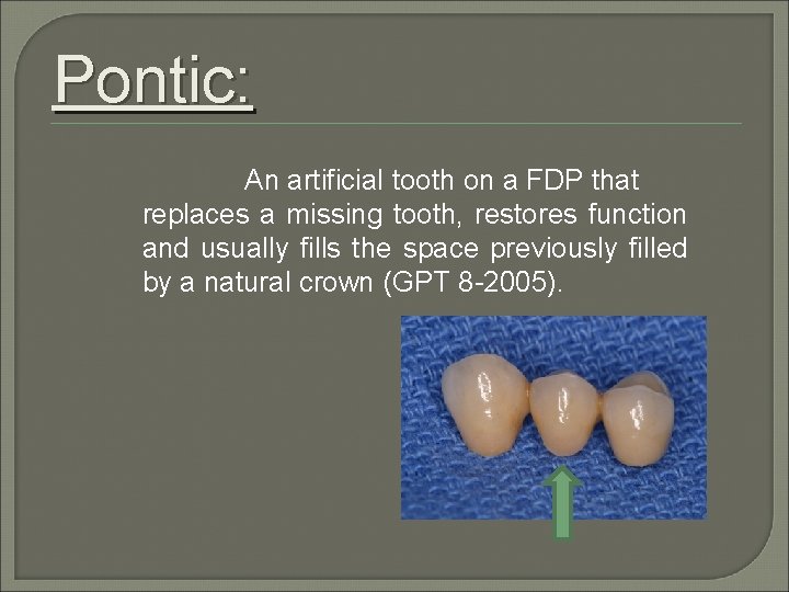 Pontic: An artificial tooth on a FDP that replaces a missing tooth, restores function