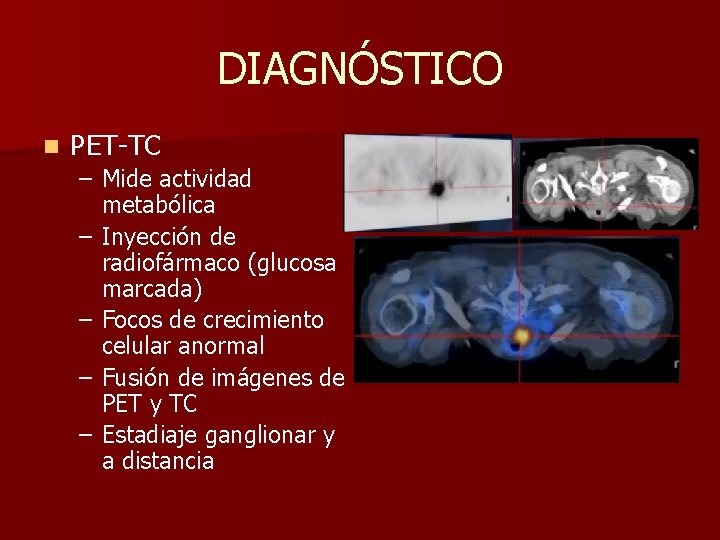 DIAGNÓSTICO n PET-TC – Mide actividad metabólica – Inyección de radiofármaco (glucosa marcada) –