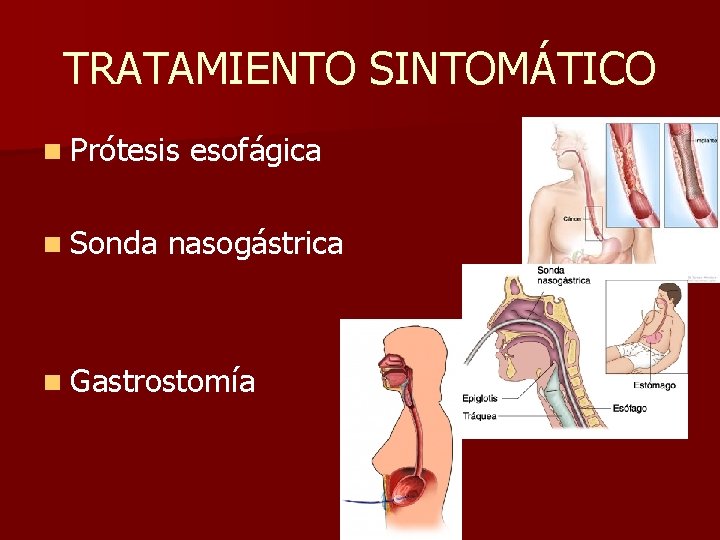 TRATAMIENTO SINTOMÁTICO n Prótesis n Sonda esofágica nasogástrica n Gastrostomía 
