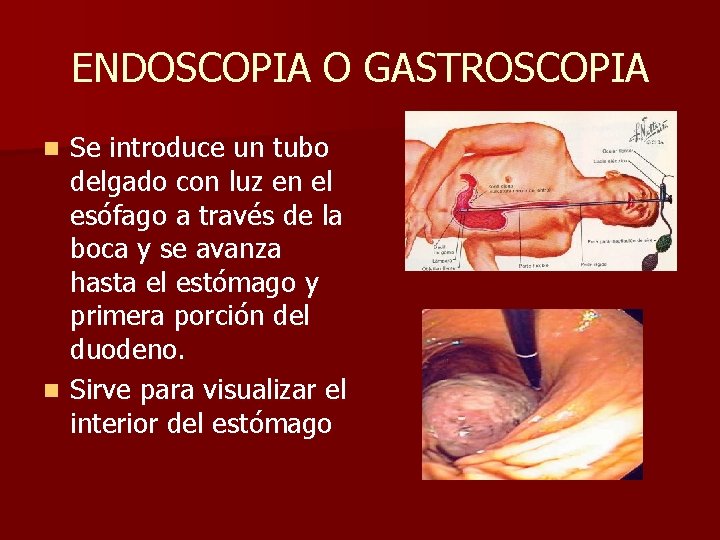 ENDOSCOPIA O GASTROSCOPIA Se introduce un tubo delgado con luz en el esófago a