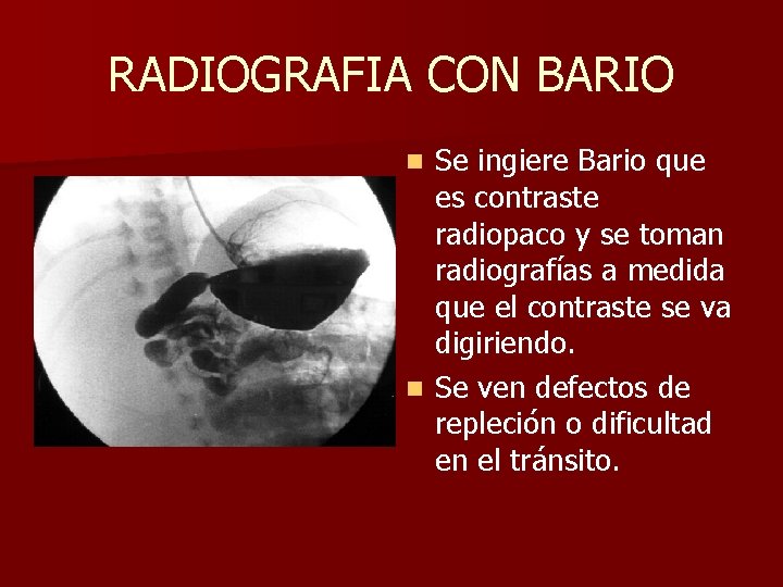 RADIOGRAFIA CON BARIO Se ingiere Bario que es contraste radiopaco y se toman radiografías