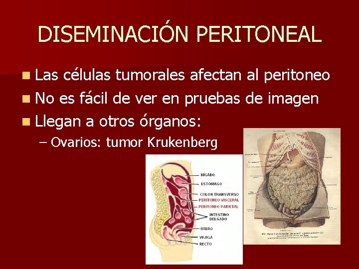 DISEMINACIÓN PERITONEAL n Las células tumorales afectan al peritoneo n No es fácil de