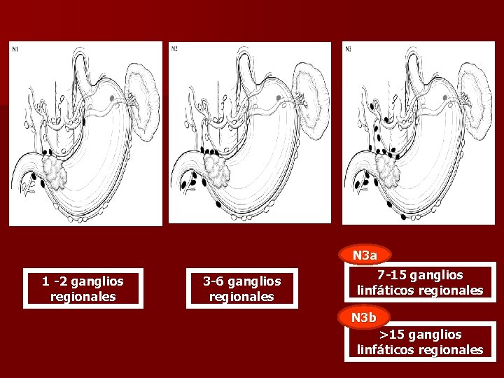 N 3 a 1 -2 ganglios regionales 3 -6 ganglios regionales 7 -15 ganglios