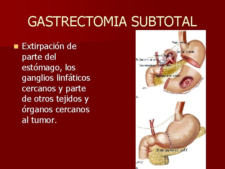 GASTRECTOMIA SUBTOTAL n Extirpación de parte del estómago, los ganglios linfáticos cercanos y parte