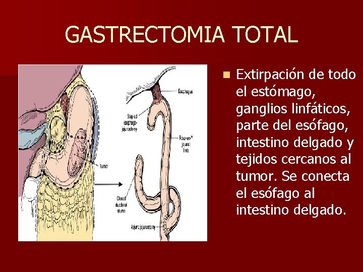 GASTRECTOMIA TOTAL n Extirpación de todo el estómago, ganglios linfáticos, parte del esófago, intestino