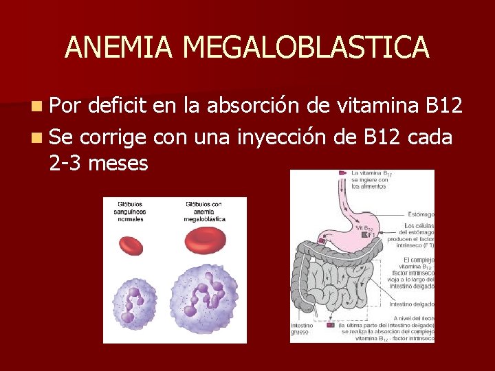 ANEMIA MEGALOBLASTICA n Por deficit en la absorción de vitamina B 12 n Se