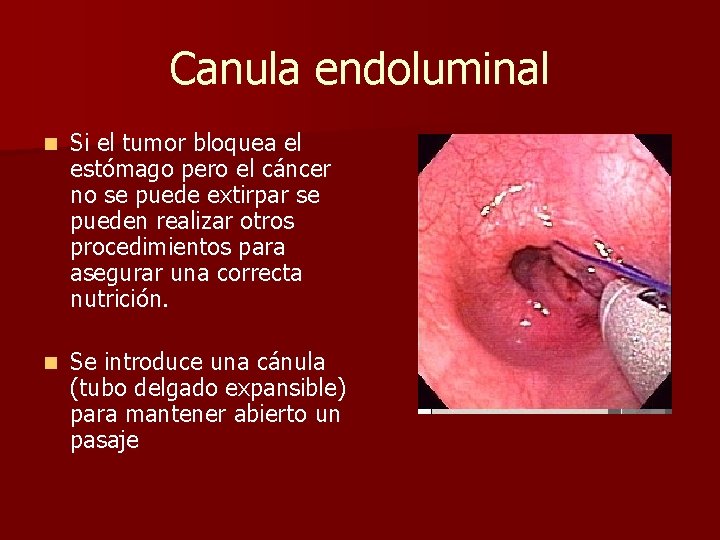Canula endoluminal n Si el tumor bloquea el estómago pero el cáncer no se