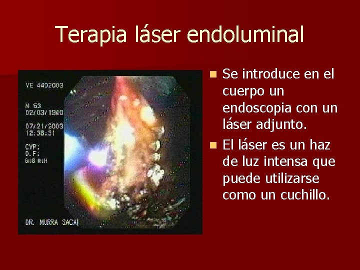 Terapia láser endoluminal Se introduce en el cuerpo un endoscopia con un láser adjunto.