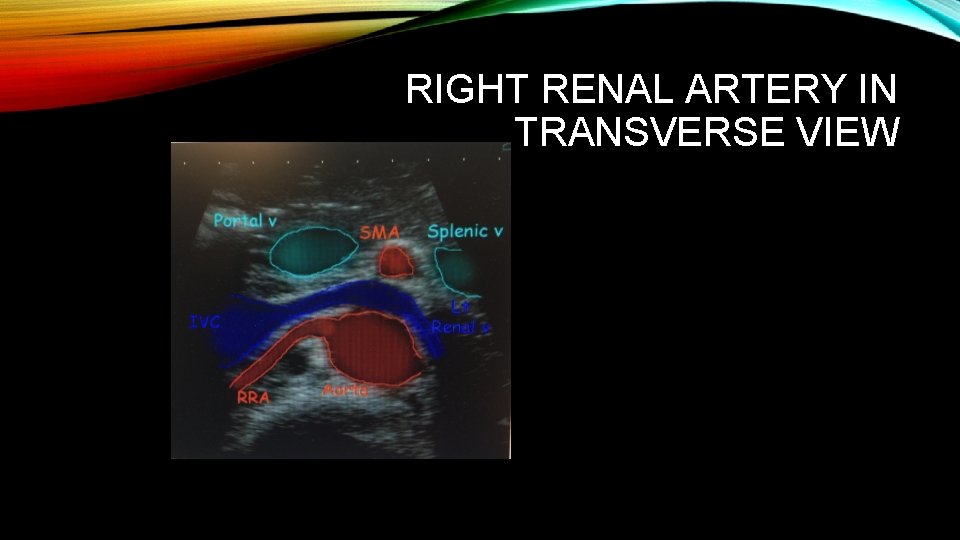 RIGHT RENAL ARTERY IN TRANSVERSE VIEW 