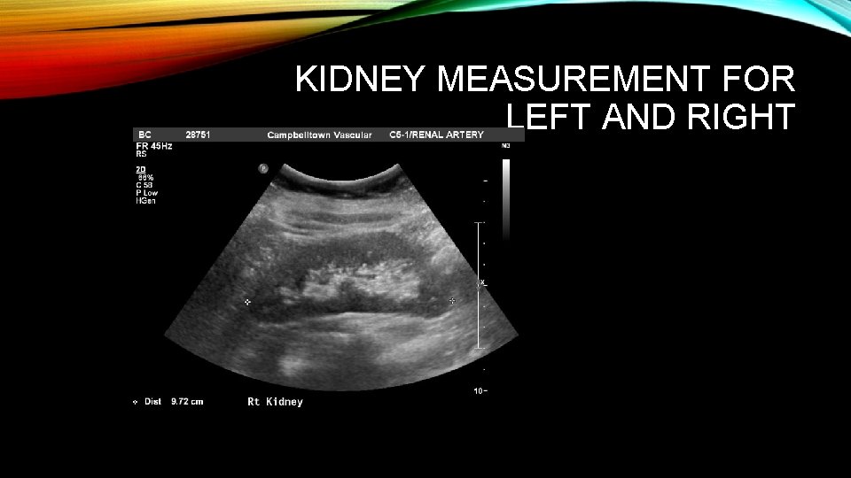 KIDNEY MEASUREMENT FOR LEFT AND RIGHT 