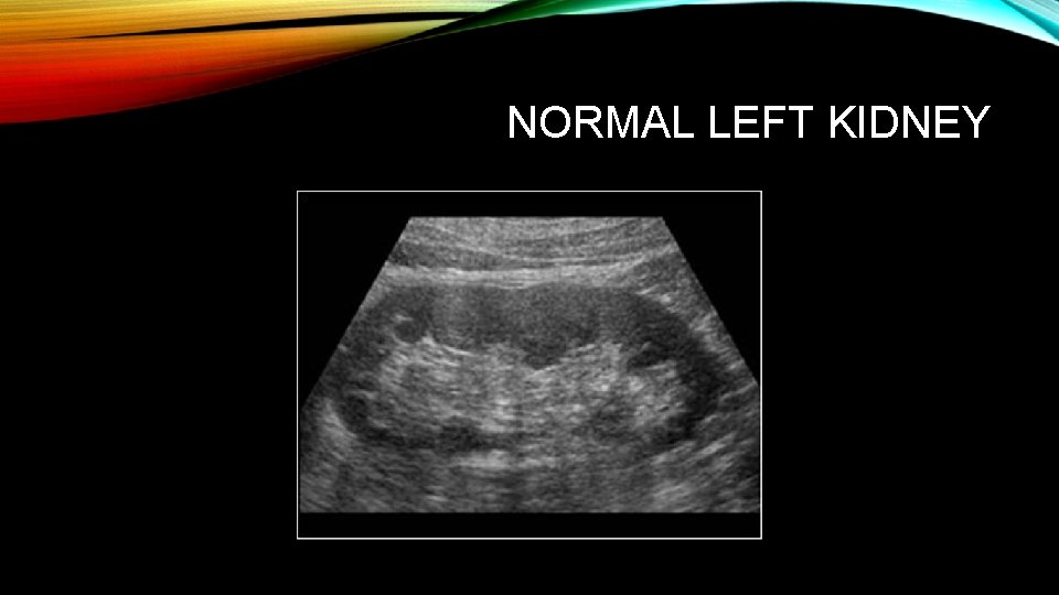 NORMAL LEFT KIDNEY 