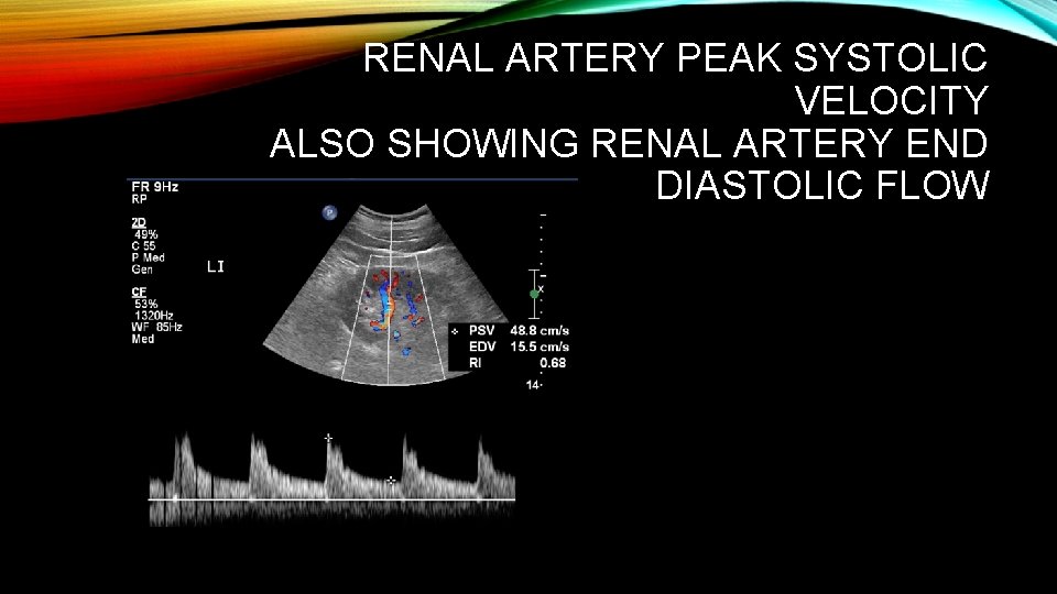 RENAL ARTERY PEAK SYSTOLIC VELOCITY ALSO SHOWING RENAL ARTERY END DIASTOLIC FLOW 