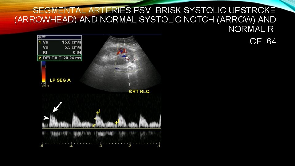 SEGMENTAL ARTERIES PSV: BRISK SYSTOLIC UPSTROKE (ARROWHEAD) AND NORMAL SYSTOLIC NOTCH (ARROW) AND NORMAL