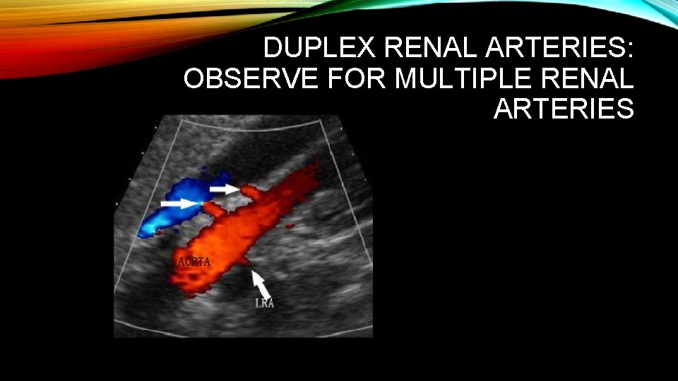 DUPLEX RENAL ARTERIES: OBSERVE FOR MULTIPLE RENAL ARTERIES 