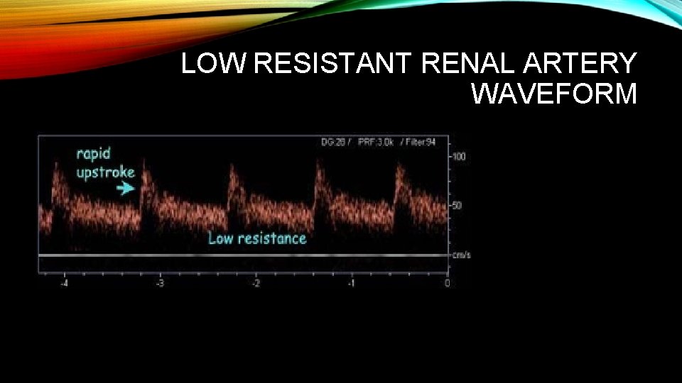 LOW RESISTANT RENAL ARTERY WAVEFORM 