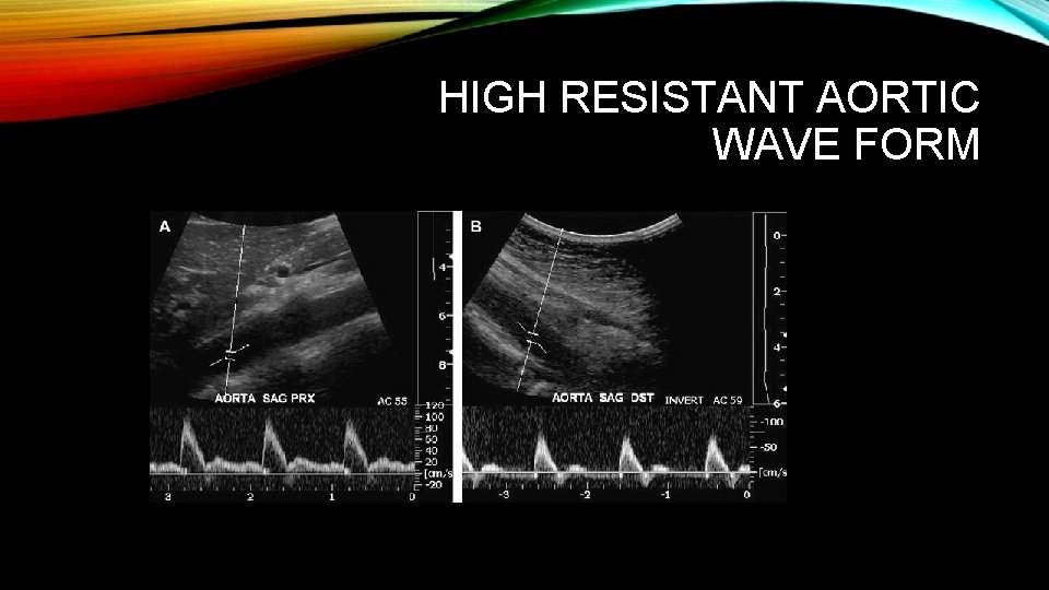 HIGH RESISTANT AORTIC WAVE FORM 