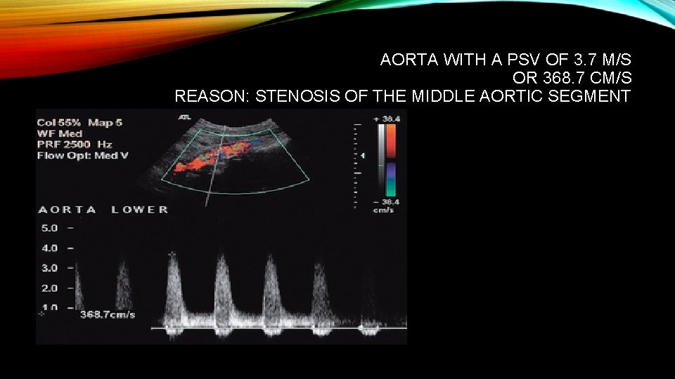 AORTA WITH A PSV OF 3. 7 M/S OR 368. 7 CM/S REASON: STENOSIS