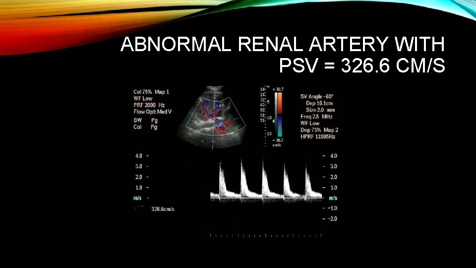 ABNORMAL RENAL ARTERY WITH PSV = 326. 6 CM/S 