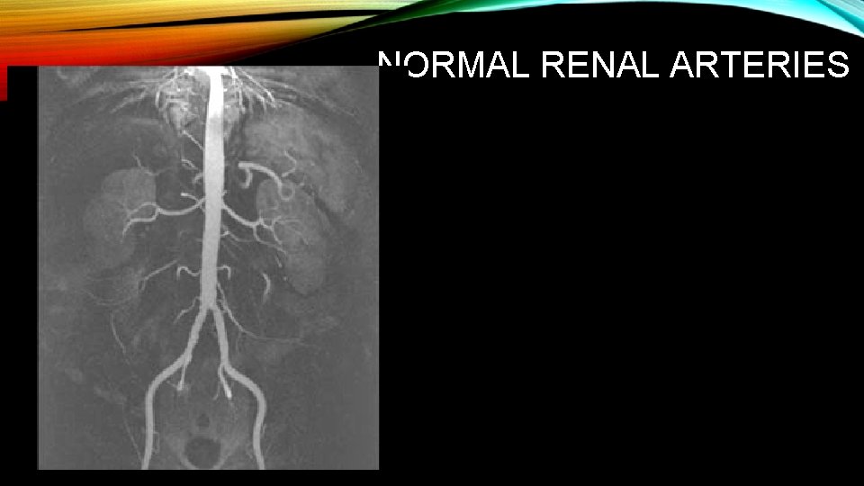 NORMAL RENAL ARTERIES 