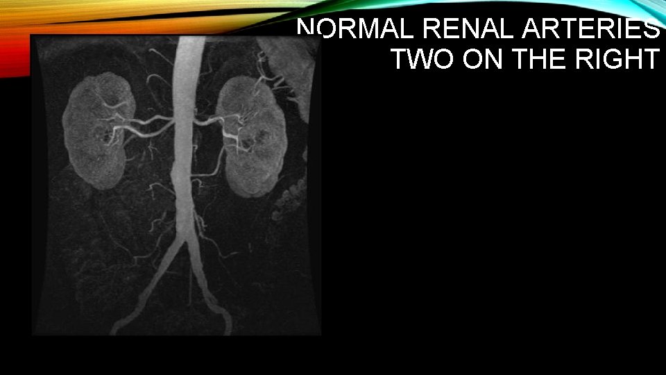 NORMAL RENAL ARTERIES TWO ON THE RIGHT 