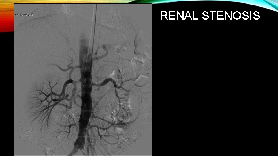 RENAL STENOSIS 